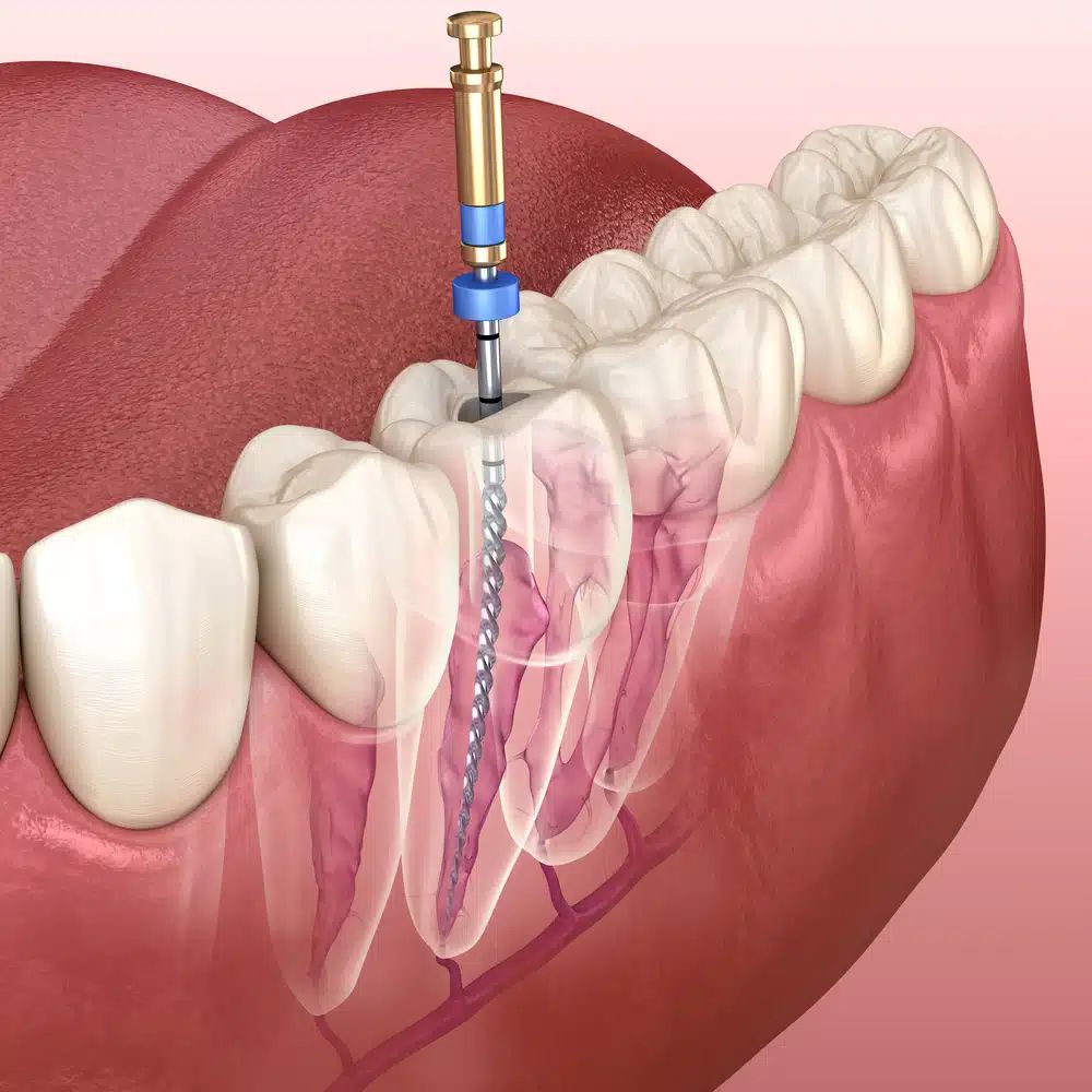 Root Canal and Endodontic Care at NY Elite Dental